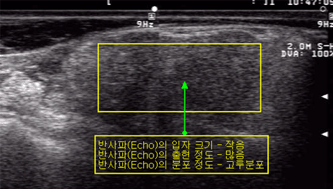 <그림 17> 근내지방도가 높은 화상